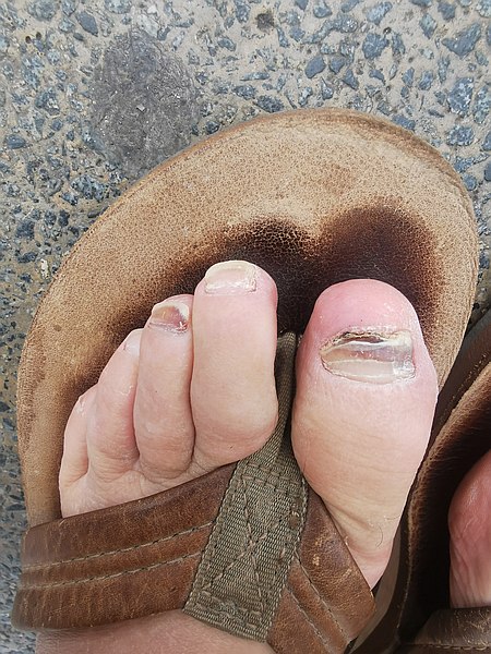 Damaged Toenails before Medical Pedicure